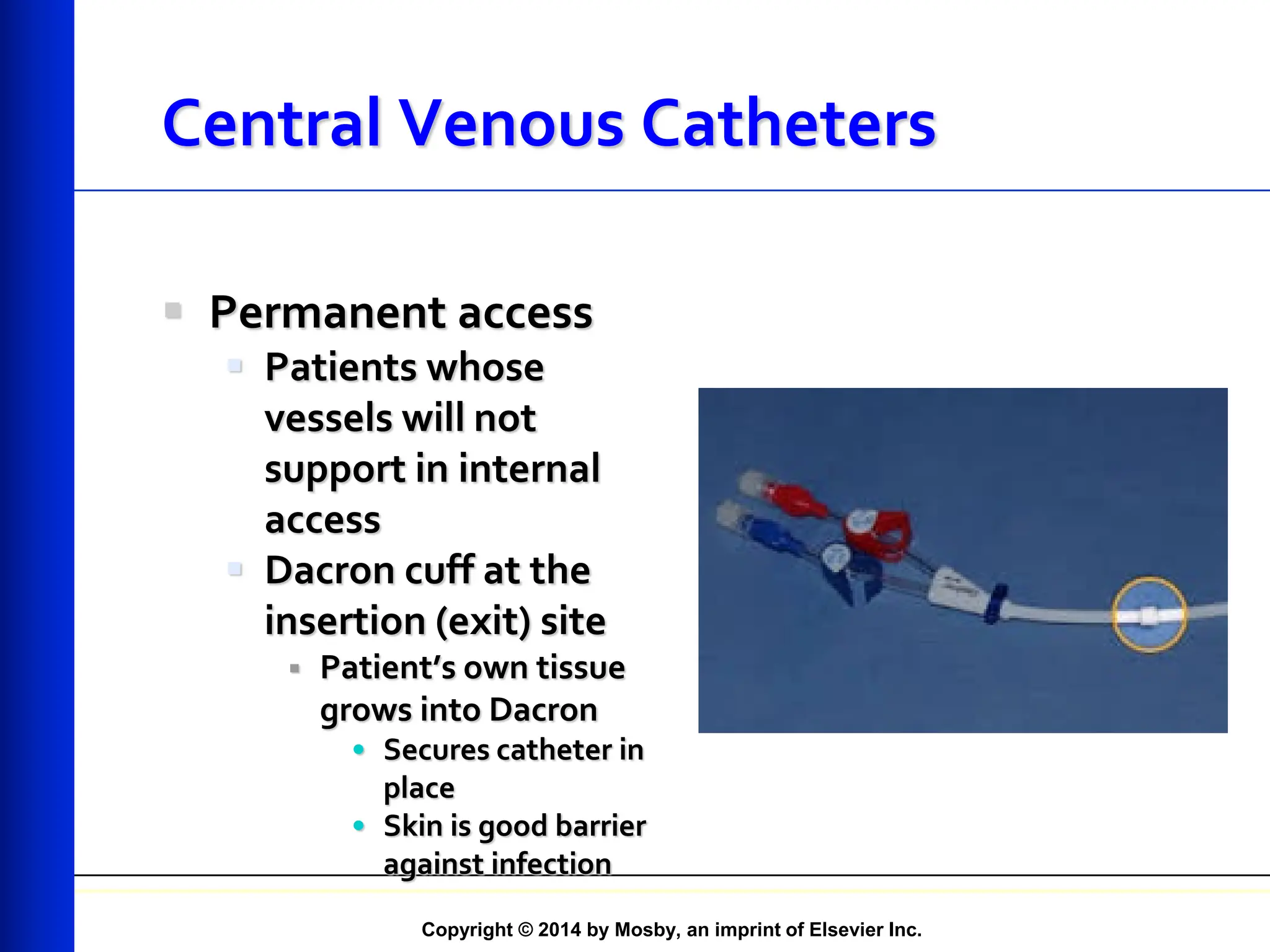 Copyright © 2014 by Mosby, an imprint of Elsevier Inc.
Central Venous Catheters
 Permanent access
 Patients whose
vessels will not
support in internal
access
 Dacron cuff at the
insertion (exit) site
 Patient’s own tissue
grows into Dacron
• Secures catheter in
place
• Skin is good barrier
against infection
 