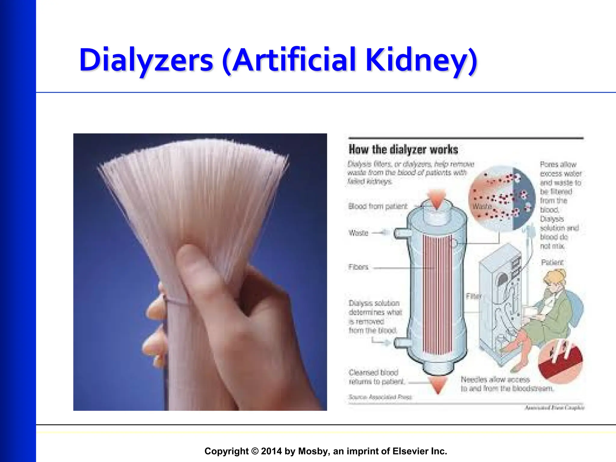 Copyright © 2014 by Mosby, an imprint of Elsevier Inc.
Dialyzers (Artificial Kidney)
 