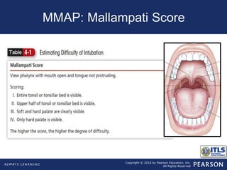Copyright © 2016 by Pearson Education, Inc.
All Rights Reserved
MMAP: Mallampati Score
 