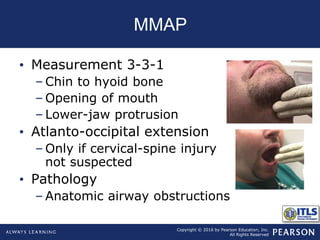 Copyright © 2016 by Pearson Education, Inc.
All Rights Reserved
MMAP
• Measurement 3-3-1
– Chin to hyoid bone
– Opening of mouth
– Lower-jaw protrusion
• Atlanto-occipital extension
– Only if cervical-spine injury
not suspected
• Pathology
– Anatomic airway obstructions
 