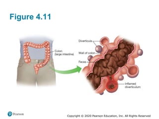 Copyright © 2020 Pearson Education, Inc. All Rights Reserved
Figure 4.11
 