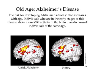 78
Old Age: Alzheimer’s Disease
The risk for developing Alzheimer’s disease also increases
with age. Individuals who are in the early stages of this
disease show more MRI activity in the brain than do normal
individuals of the same age.
At risk Alzheimer Normal
SusanBookheimer
 