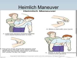 Heimlich Maneuver
 