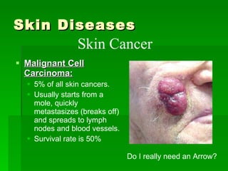 Skin Diseases  Malignant  Cell  Carcinoma:   5% of all skin cancers.  Usually starts from a mole, quickly metastasizes (breaks off) and spreads to lymph nodes and blood vessels.  Survival rate is 50%  Skin Cancer  Do I really need an Arrow? 