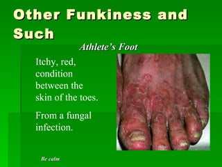 Other Funkiness and Such  Athlete’s Foot  Itchy, red, condition between the skin of the toes.  From a fungal infection. Be calm 