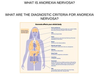 WHAT IS ANOREXIA NERVOSA? WHAT ARE THE DIAGNOSTIC CRITERIA FOR ANOREXIA NERVOSA? 