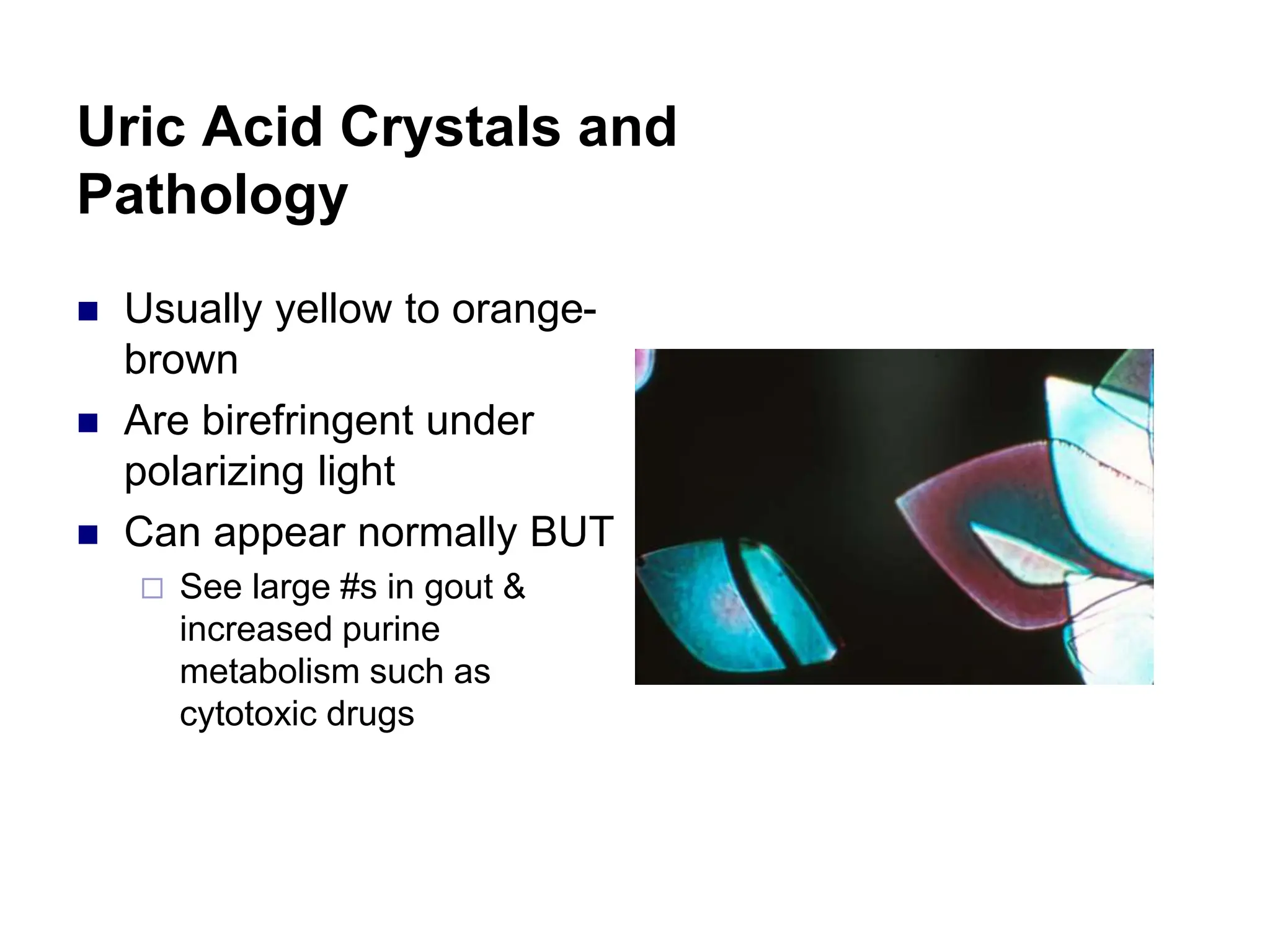 Uric Acid Crystals and
Pathology
 Usually yellow to orange-
brown
 Are birefringent under
polarizing light
 Can appear normally BUT
 See large #s in gout &
increased purine
metabolism such as
cytotoxic drugs
 