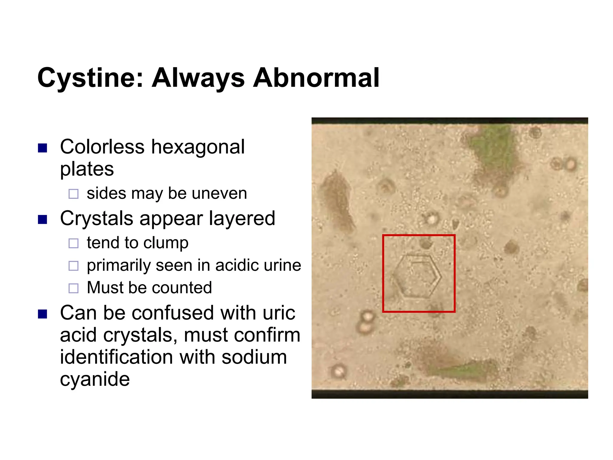 Cystine: Always Abnormal
 Colorless hexagonal
plates
 sides may be uneven
 Crystals appear layered
 tend to clump
 primarily seen in acidic urine
 Must be counted
 Can be confused with uric
acid crystals, must confirm
identification with sodium
cyanide
 