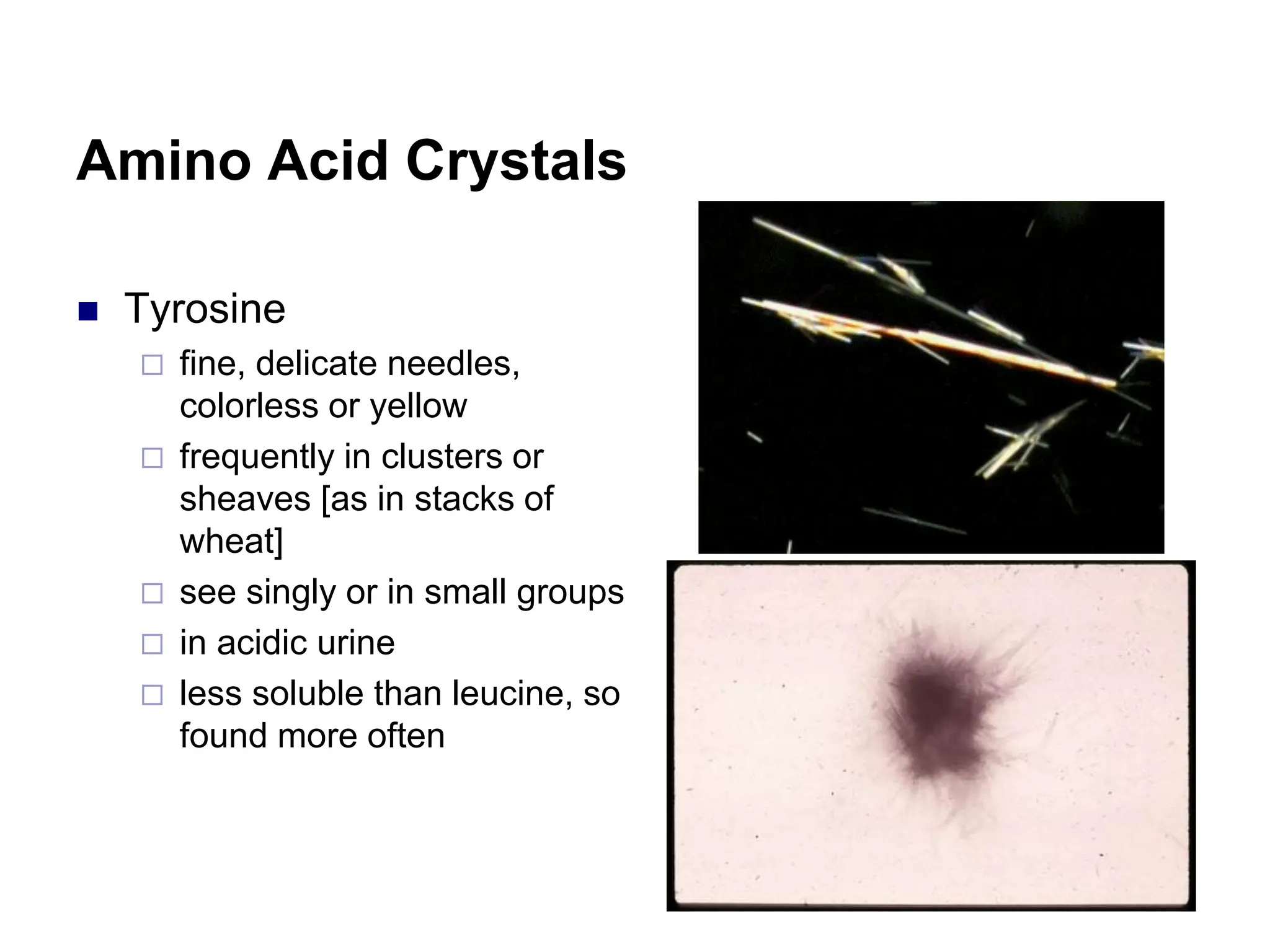 Amino Acid Crystals
 Tyrosine
 fine, delicate needles,
colorless or yellow
 frequently in clusters or
sheaves [as in stacks of
wheat]
 see singly or in small groups
 in acidic urine
 less soluble than leucine, so
found more often
 
