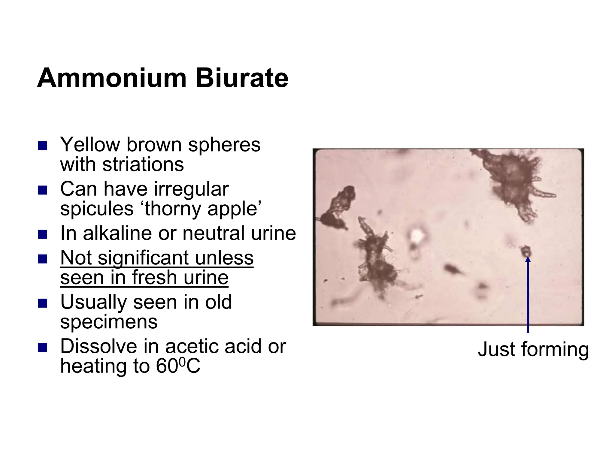 Ammonium Biurate
 Yellow brown spheres
with striations
 Can have irregular
spicules ‘thorny apple’
 In alkaline or neutral urine
 Not significant unless
seen in fresh urine
 Usually seen in old
specimens
 Dissolve in acetic acid or
heating to 600C
Just forming
 