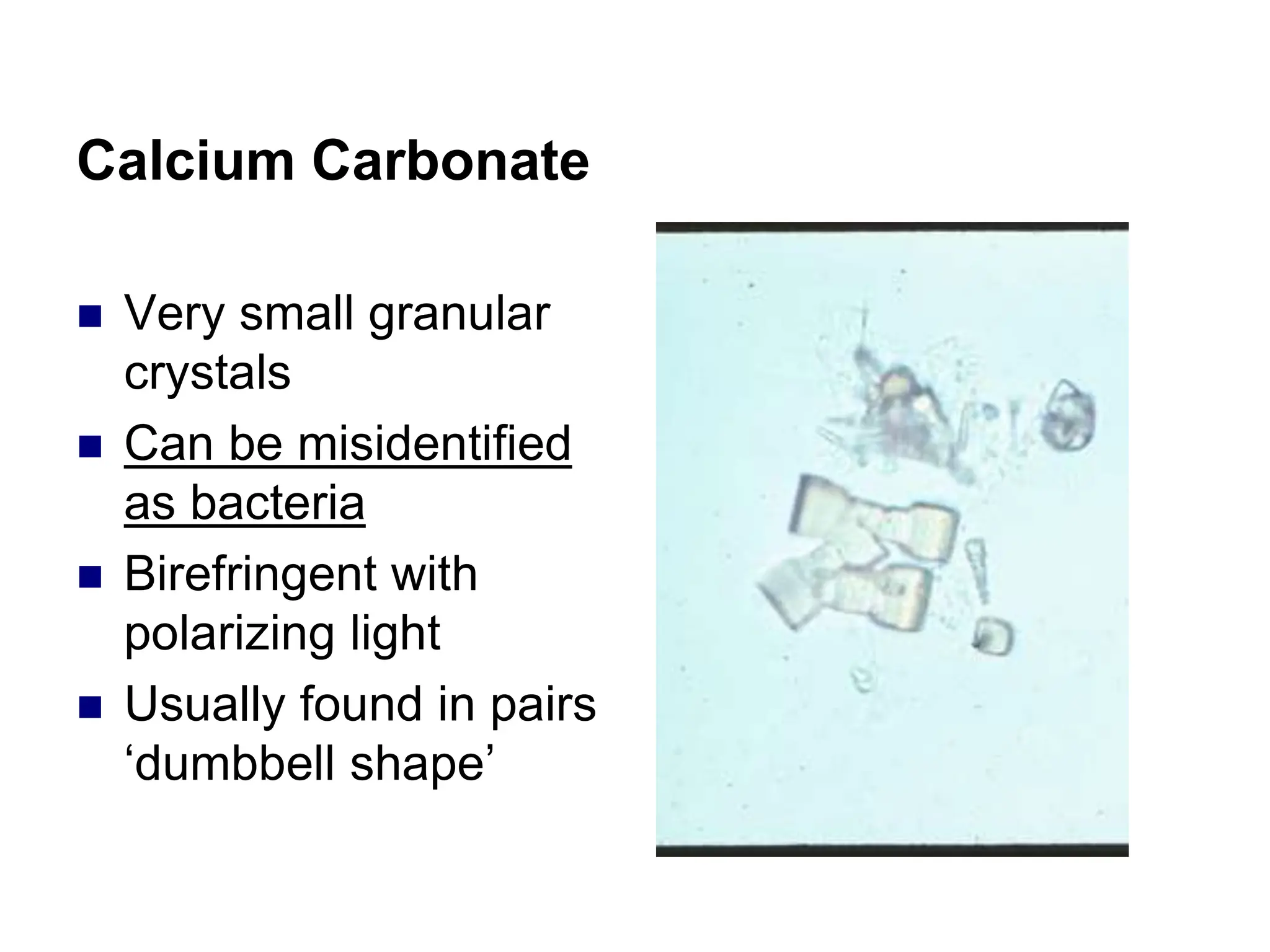 Calcium Carbonate
 Very small granular
crystals
 Can be misidentified
as bacteria
 Birefringent with
polarizing light
 Usually found in pairs
‘dumbbell shape’
 