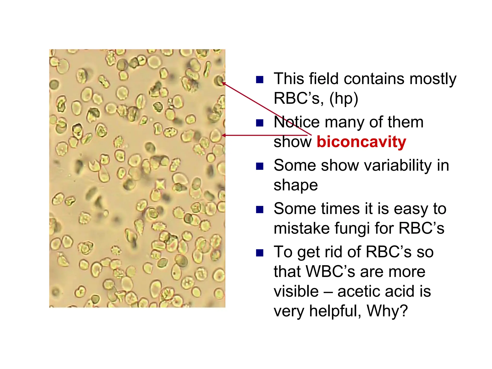  This field contains mostly
RBC’s, (hp)
 Notice many of them
show biconcavity
 Some show variability in
shape
 Some times it is easy to
mistake fungi for RBC’s
 To get rid of RBC’s so
that WBC’s are more
visible – acetic acid is
very helpful, Why?
 