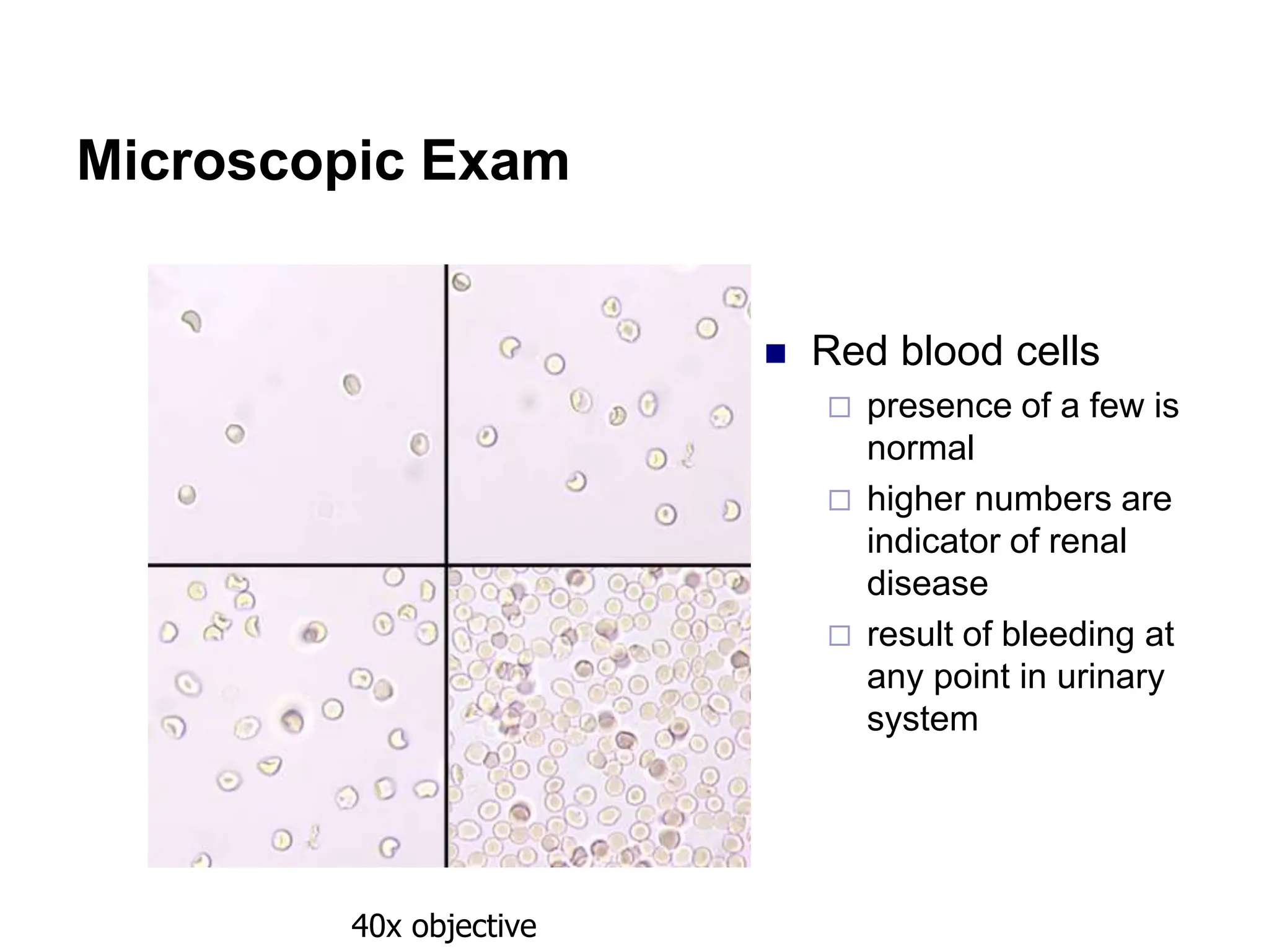 Microscopic Exam
 Red blood cells
 presence of a few is
normal
 higher numbers are
indicator of renal
disease
 result of bleeding at
any point in urinary
system
40x objective
 