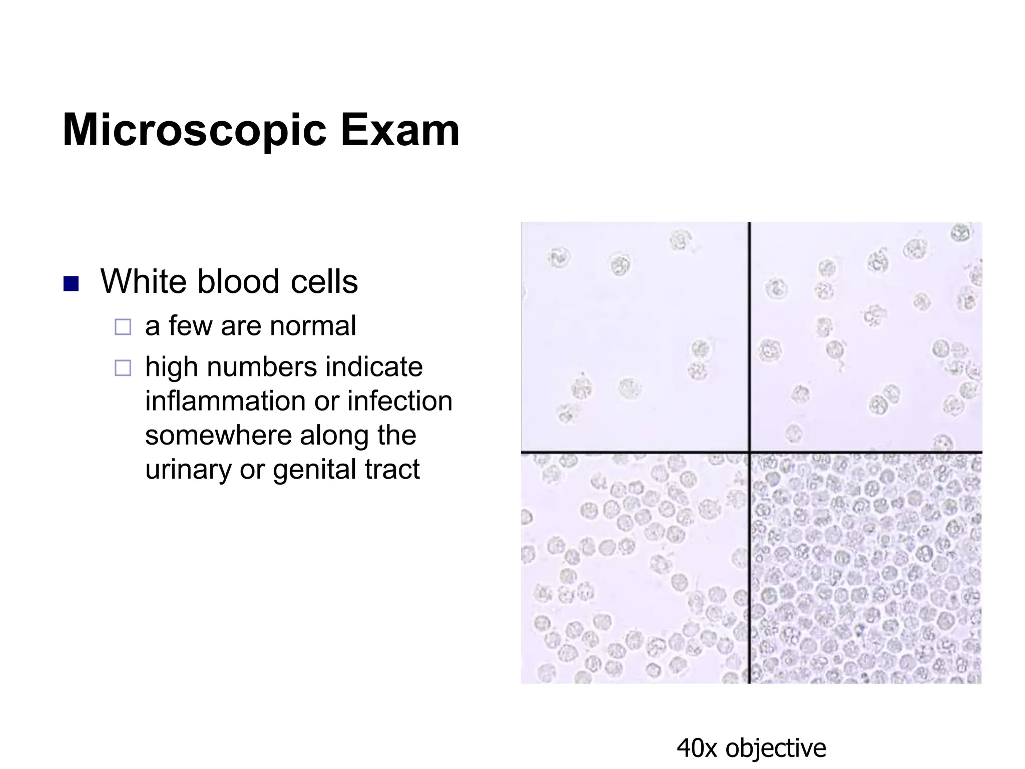 Microscopic Exam
 White blood cells
 a few are normal
 high numbers indicate
inflammation or infection
somewhere along the
urinary or genital tract
40x objective
 