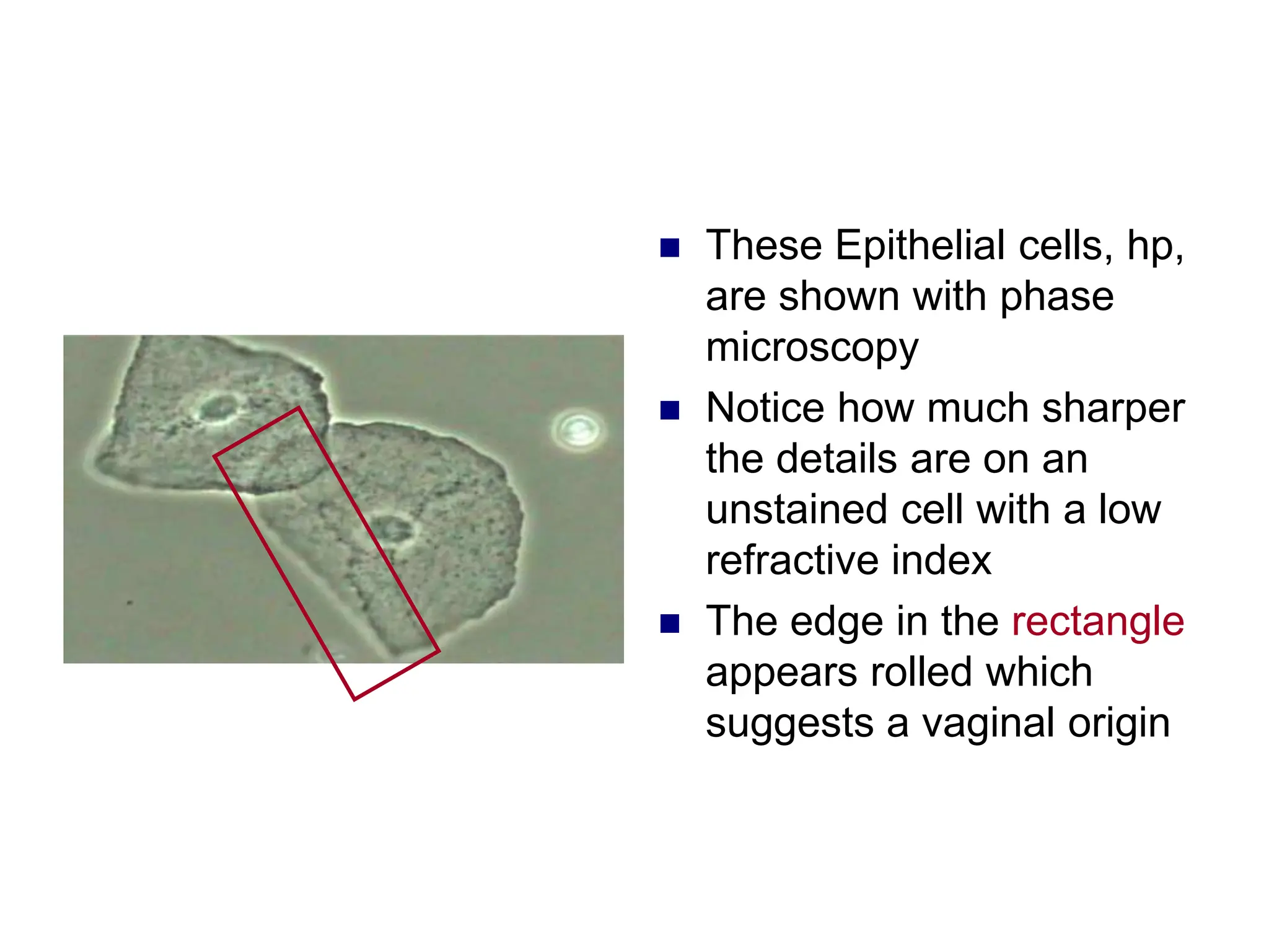  These Epithelial cells, hp,
are shown with phase
microscopy
 Notice how much sharper
the details are on an
unstained cell with a low
refractive index
 The edge in the rectangle
appears rolled which
suggests a vaginal origin
 
