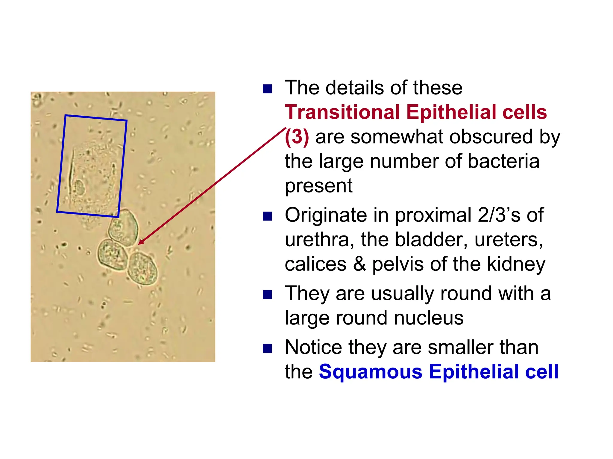  The details of these
Transitional Epithelial cells
(3) are somewhat obscured by
the large number of bacteria
present
 Originate in proximal 2/3’s of
urethra, the bladder, ureters,
calices & pelvis of the kidney
 They are usually round with a
large round nucleus
 Notice they are smaller than
the Squamous Epithelial cell
 