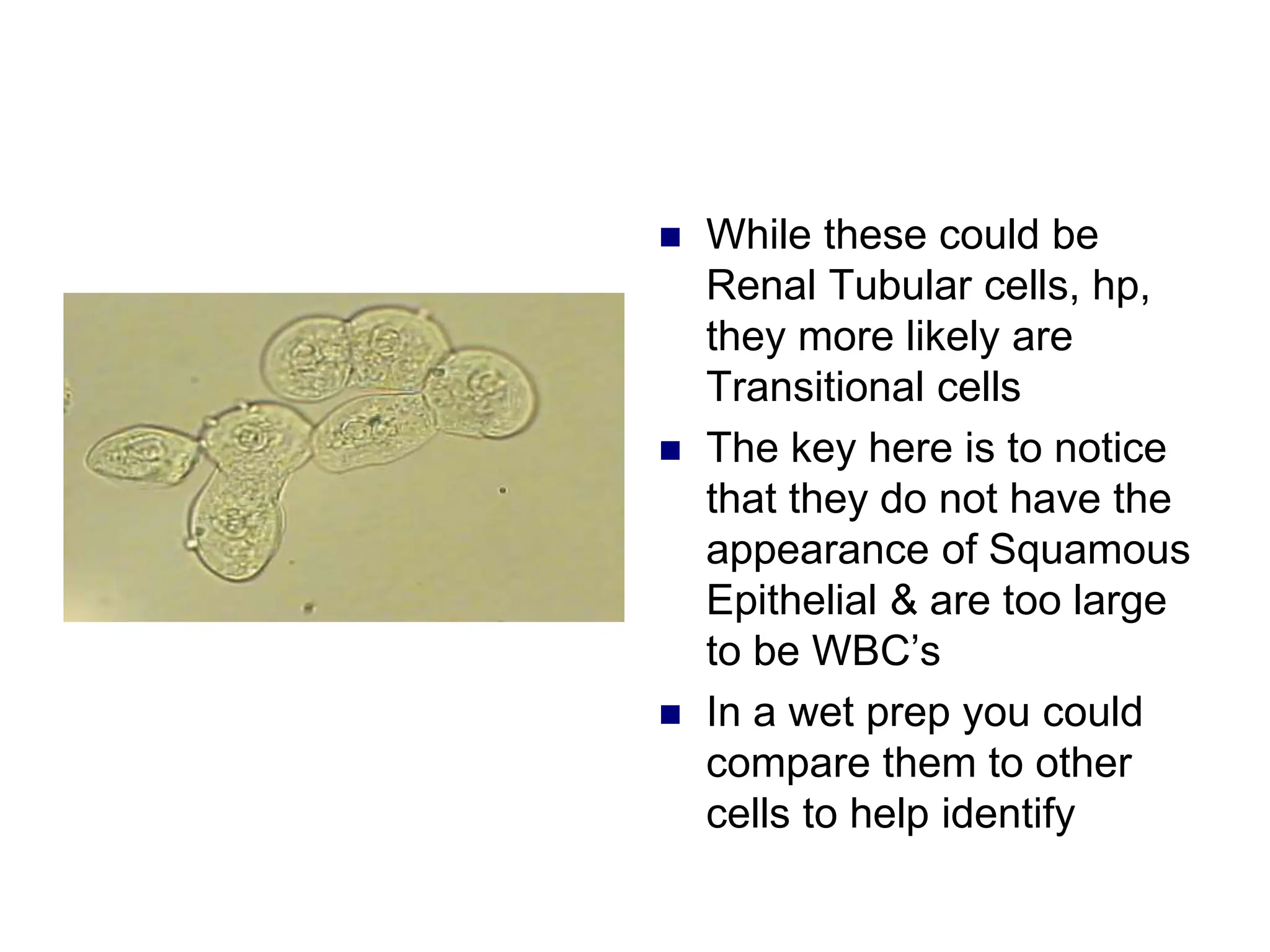  While these could be
Renal Tubular cells, hp,
they more likely are
Transitional cells
 The key here is to notice
that they do not have the
appearance of Squamous
Epithelial & are too large
to be WBC’s
 In a wet prep you could
compare them to other
cells to help identify
 