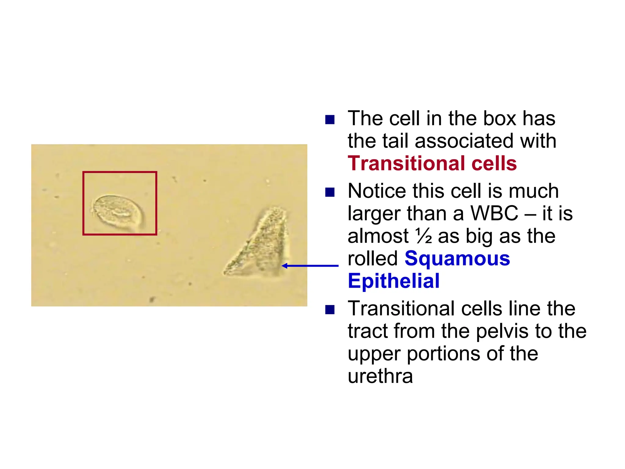  The cell in the box has
the tail associated with
Transitional cells
 Notice this cell is much
larger than a WBC – it is
almost ½ as big as the
rolled Squamous
Epithelial
 Transitional cells line the
tract from the pelvis to the
upper portions of the
urethra
 