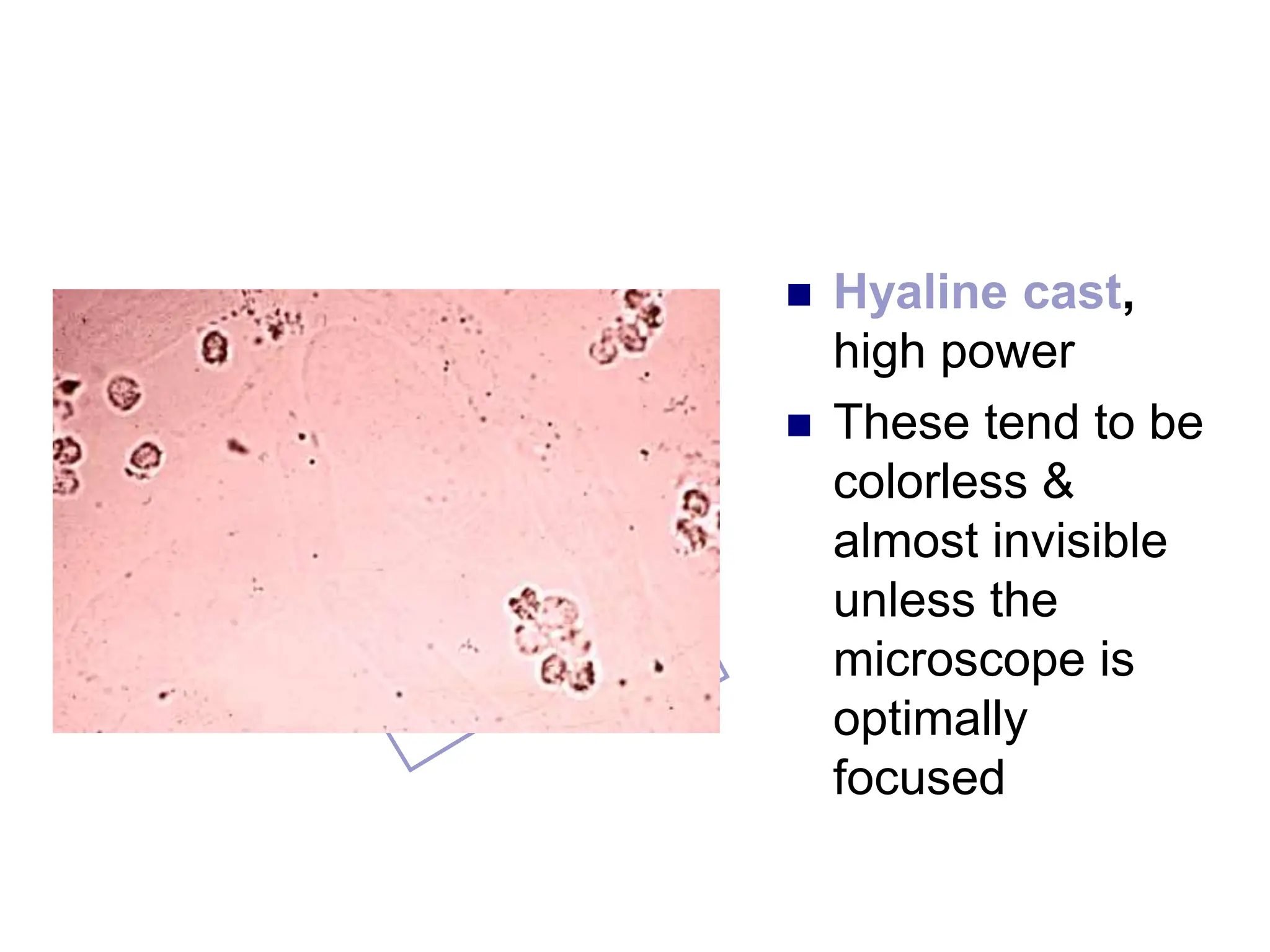  Hyaline cast,
high power
 These tend to be
colorless &
almost invisible
unless the
microscope is
optimally
focused
 