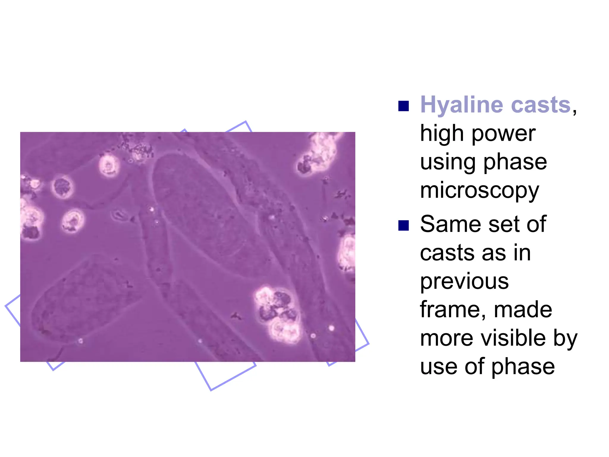  Hyaline casts,
high power
using phase
microscopy
 Same set of
casts as in
previous
frame, made
more visible by
use of phase
 