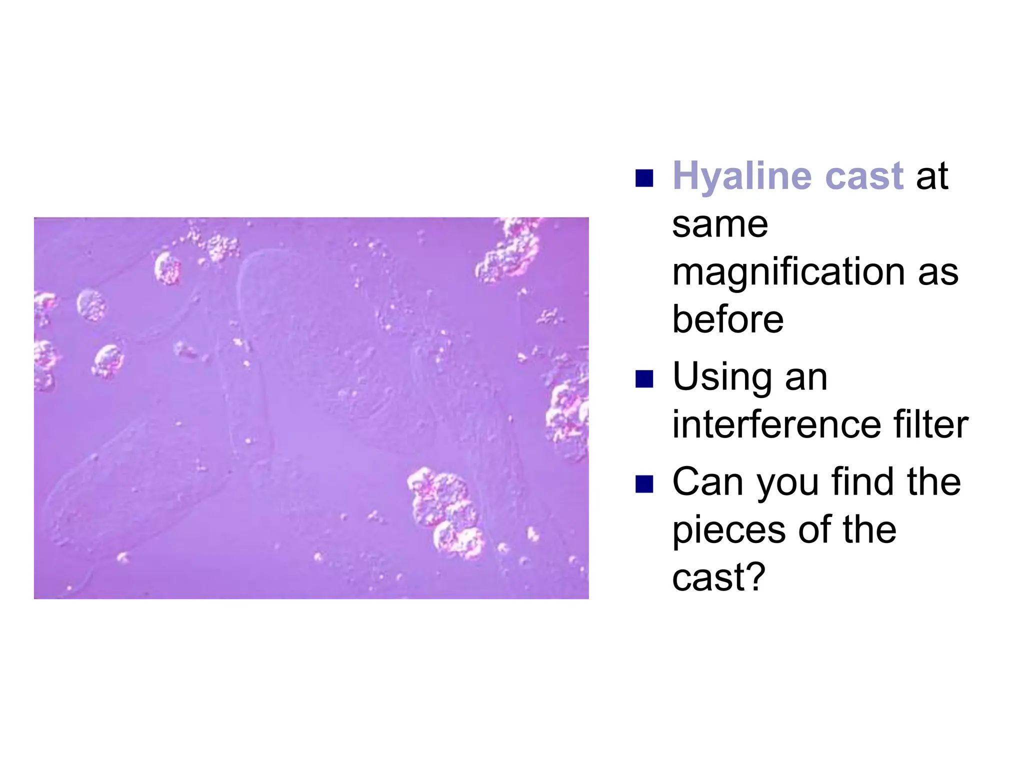  Hyaline cast at
same
magnification as
before
 Using an
interference filter
 Can you find the
pieces of the
cast?
 