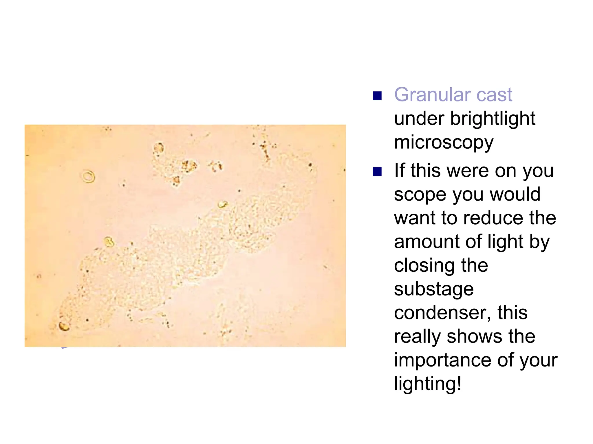  Granular cast
under brightlight
microscopy
 If this were on you
scope you would
want to reduce the
amount of light by
closing the
substage
condenser, this
really shows the
importance of your
lighting!
 