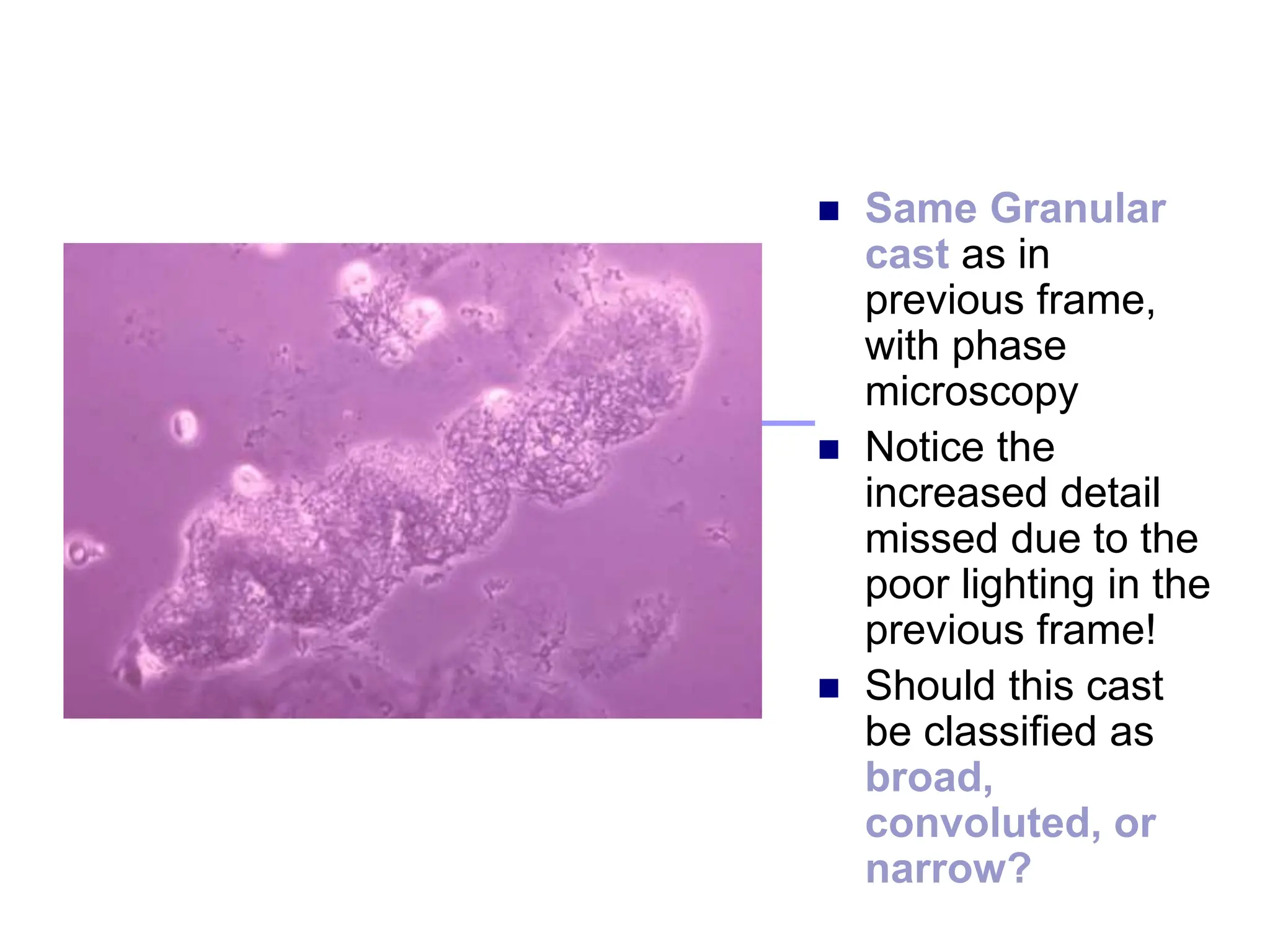 Same Granular
cast as in
previous frame,
with phase
microscopy
 Notice the
increased detail
missed due to the
poor lighting in the
previous frame!
 Should this cast
be classified as
broad,
convoluted, or
narrow?
 