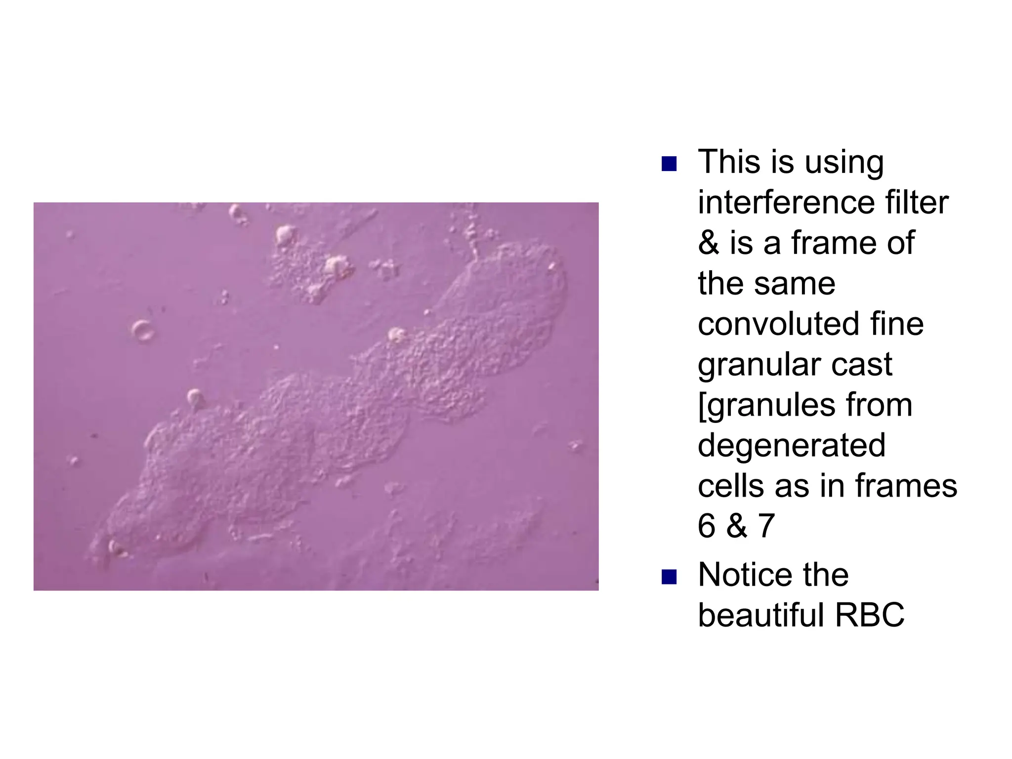  This is using
interference filter
& is a frame of
the same
convoluted fine
granular cast
[granules from
degenerated
cells as in frames
6 & 7
 Notice the
beautiful RBC
 