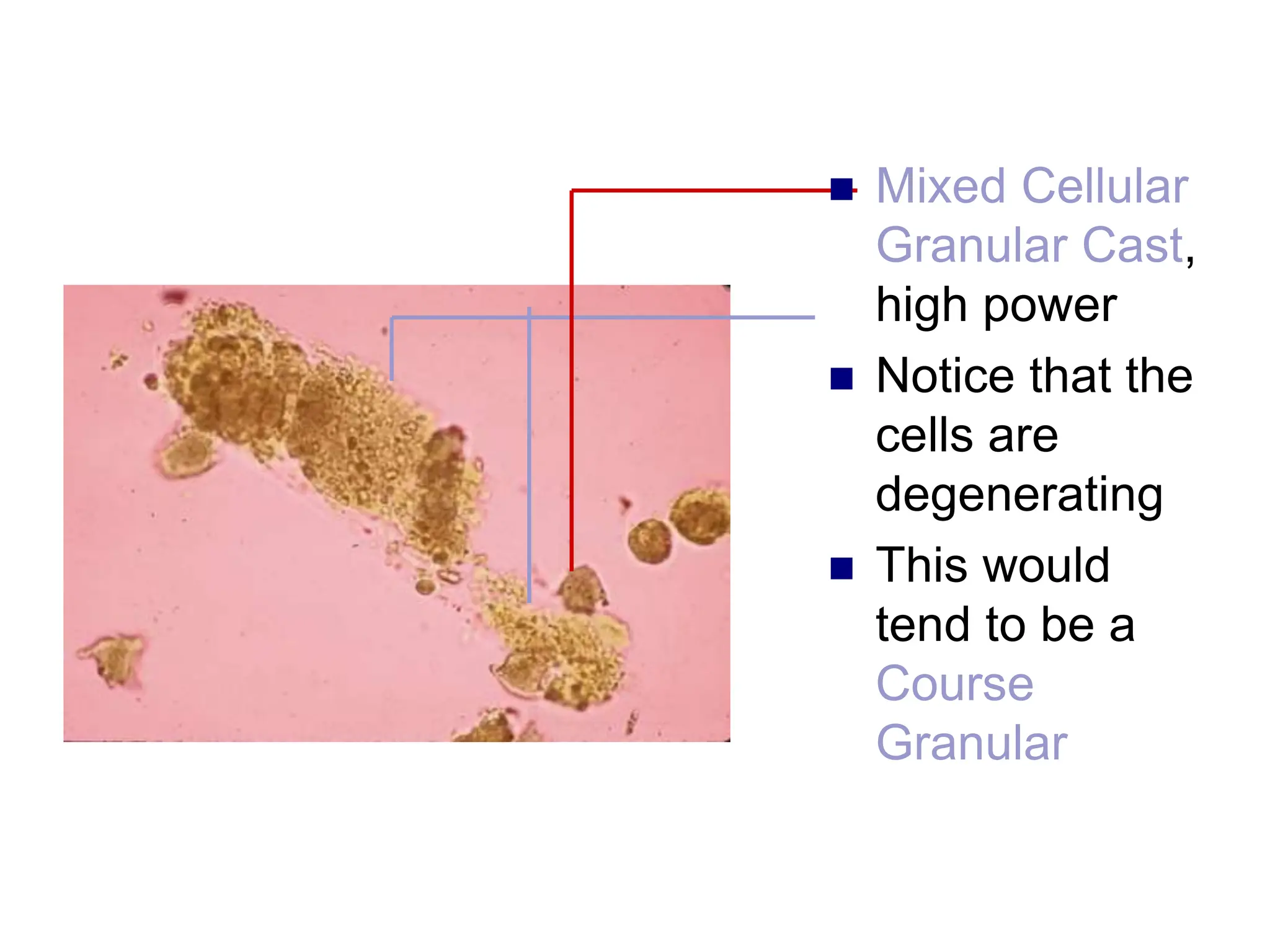 Mixed Cellular
Granular Cast,
high power
 Notice that the
cells are
degenerating
 This would
tend to be a
Course
Granular
 