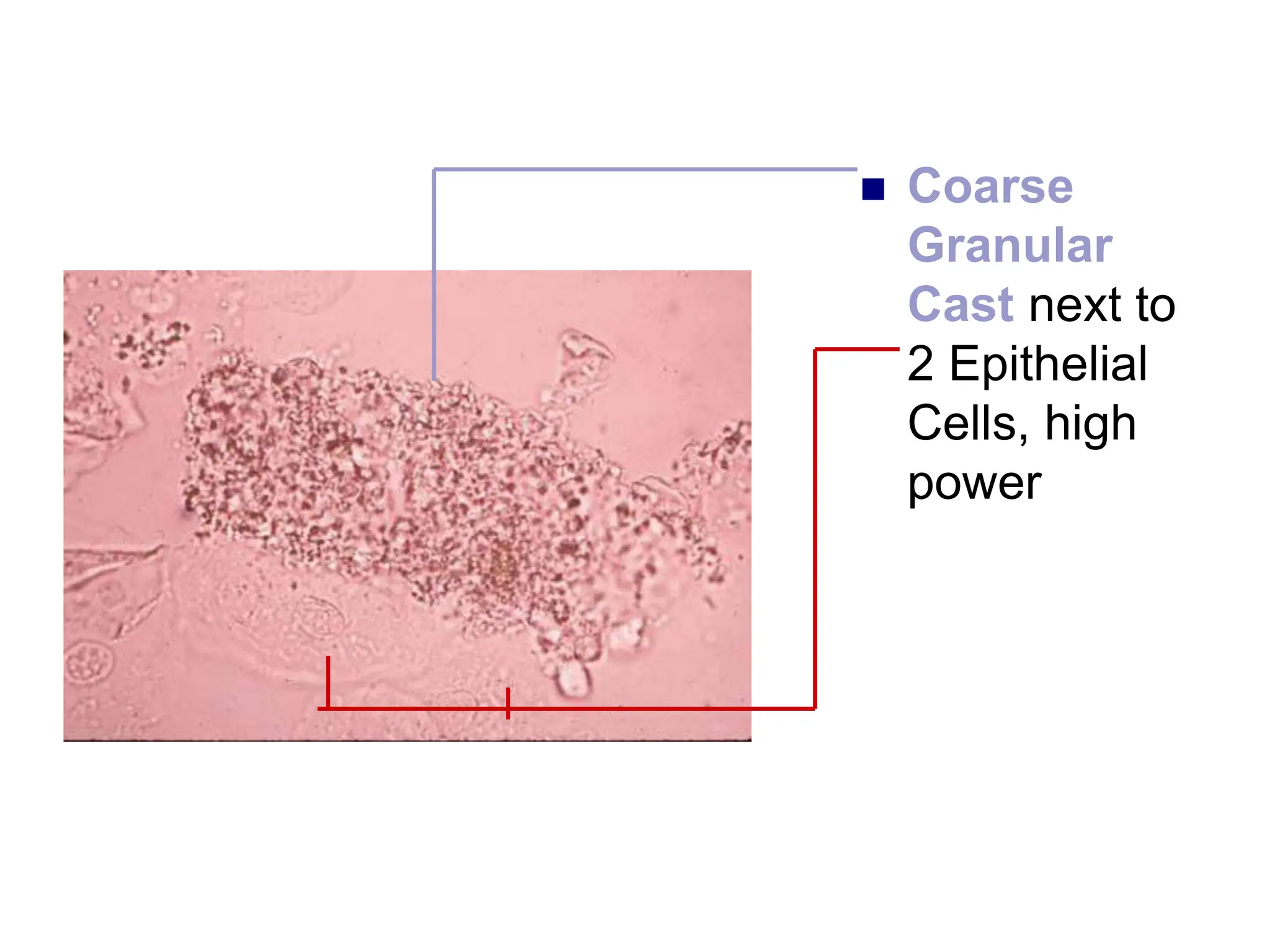  Coarse
Granular
Cast next to
2 Epithelial
Cells, high
power
 
