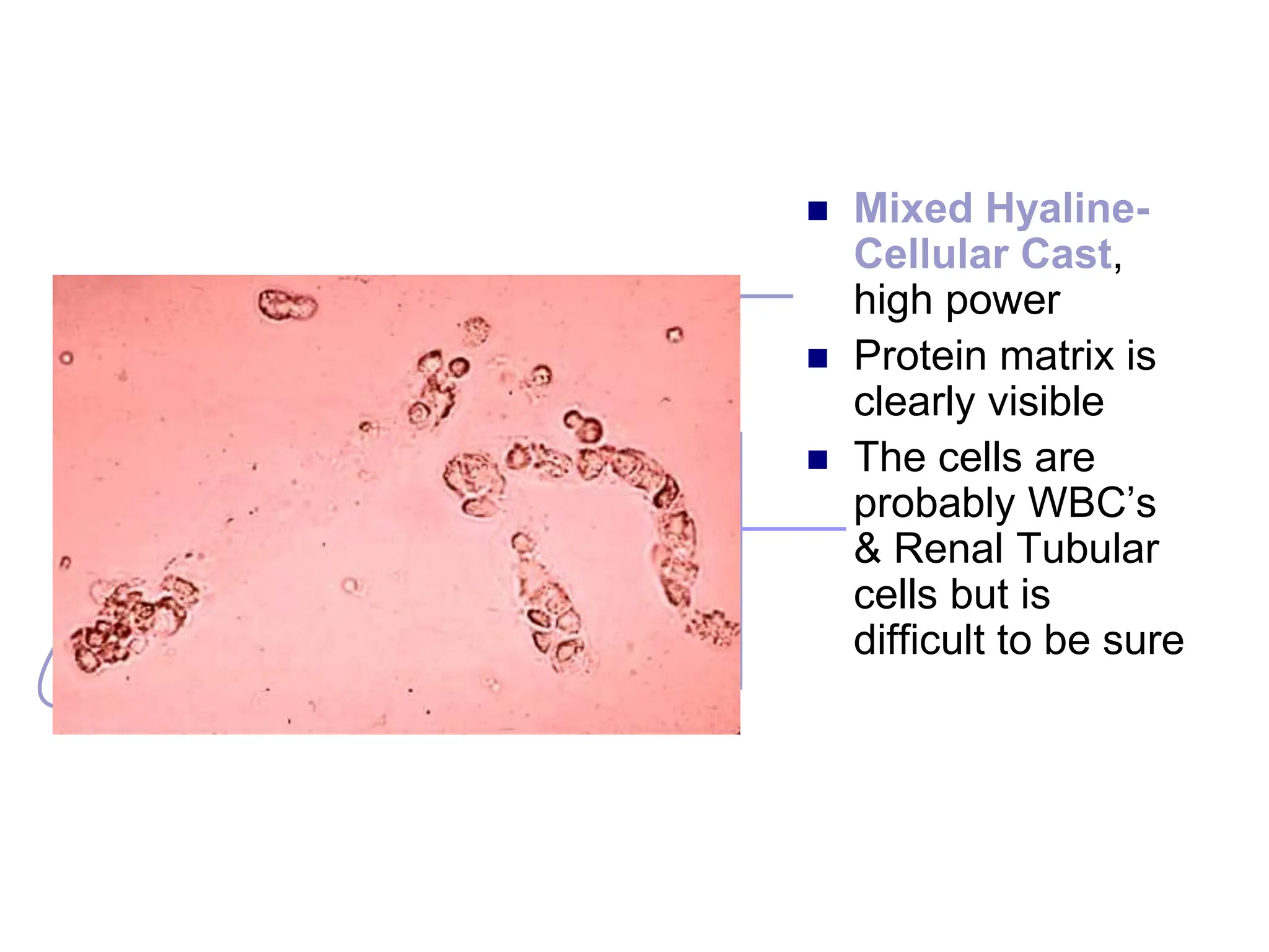  Mixed Hyaline-
Cellular Cast,
high power
 Protein matrix is
clearly visible
 The cells are
probably WBC’s
& Renal Tubular
cells but is
difficult to be sure
 