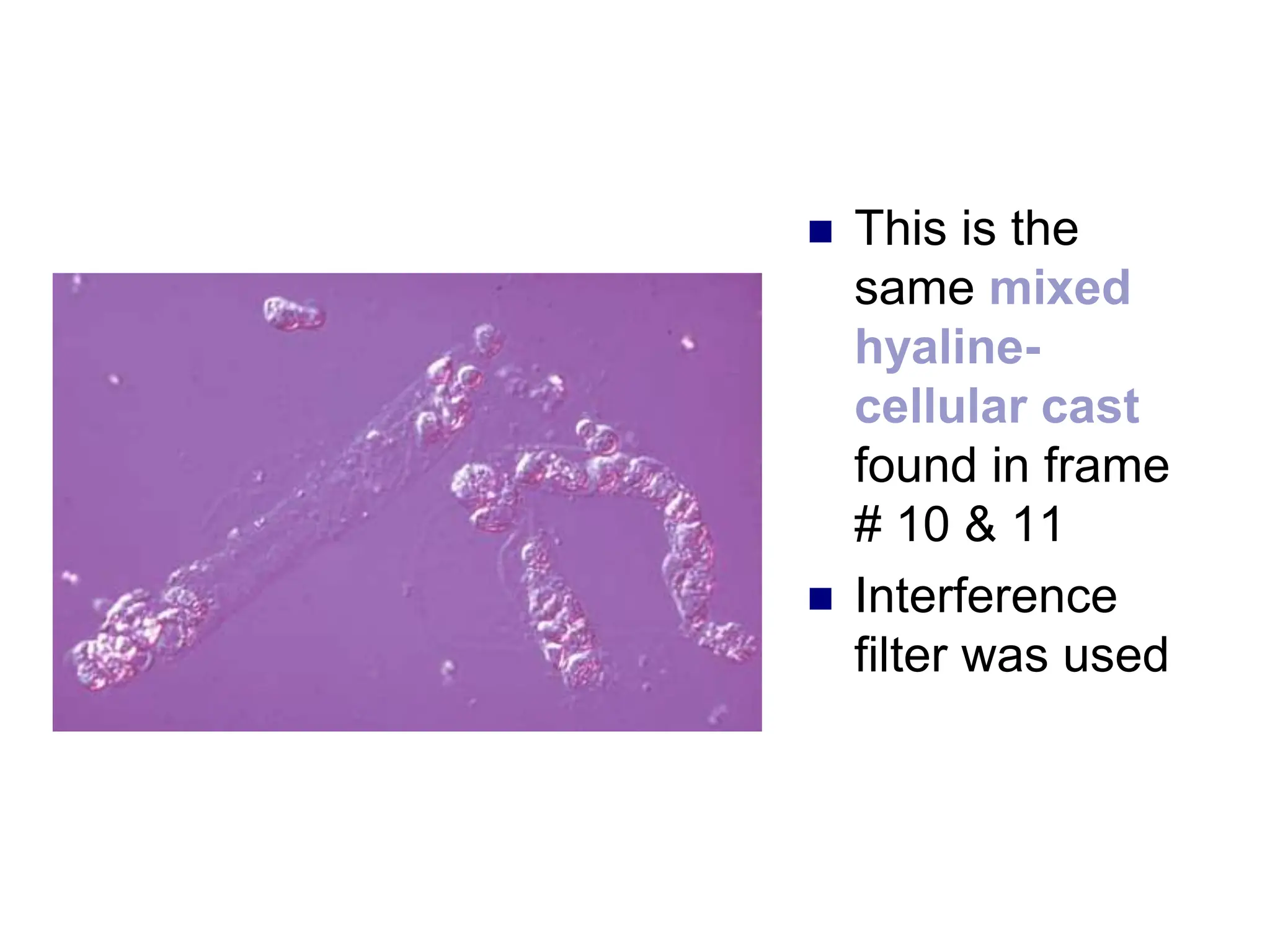  This is the
same mixed
hyaline-
cellular cast
found in frame
# 10 & 11
 Interference
filter was used
 