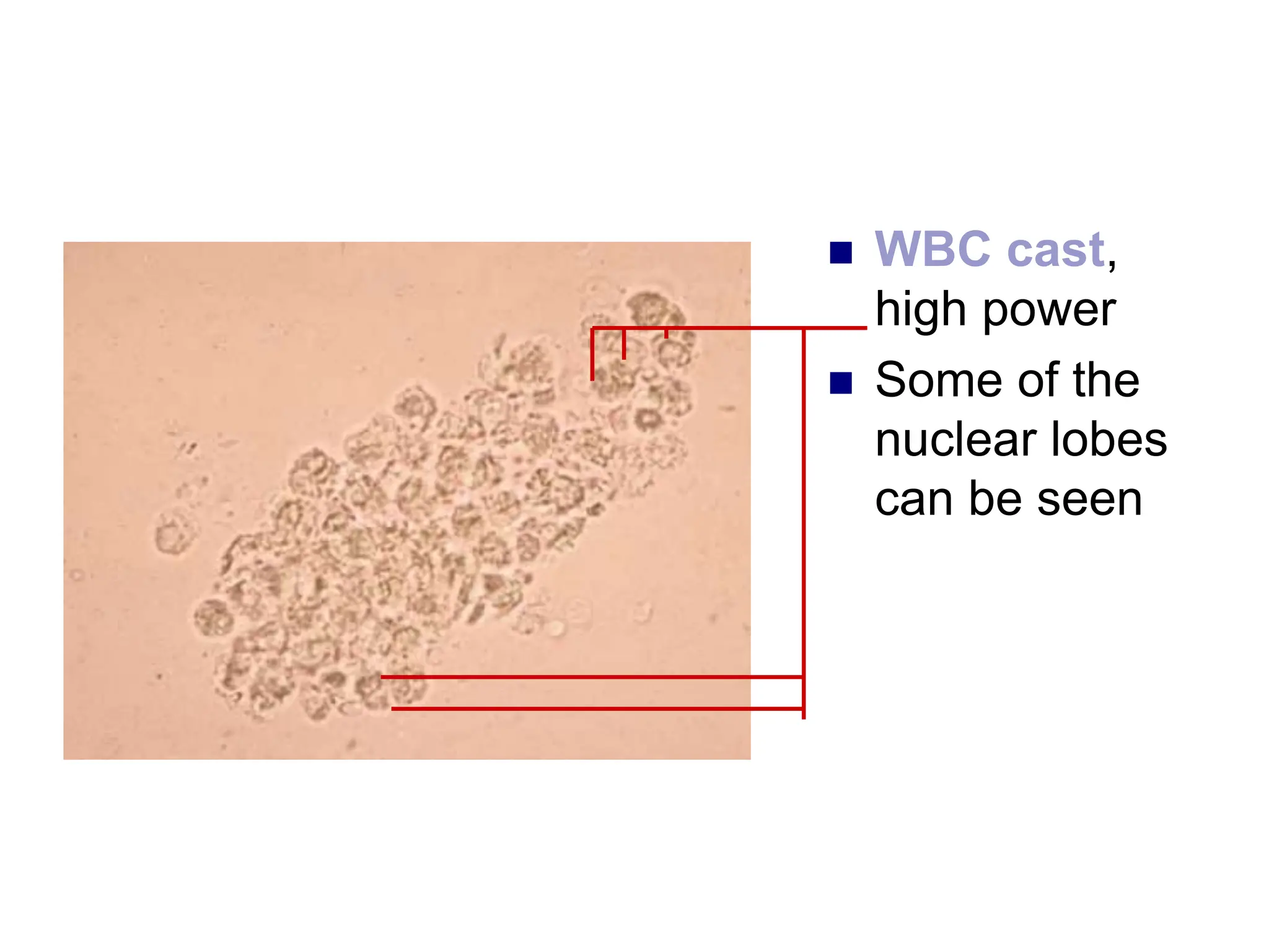  WBC cast,
high power
 Some of the
nuclear lobes
can be seen
 