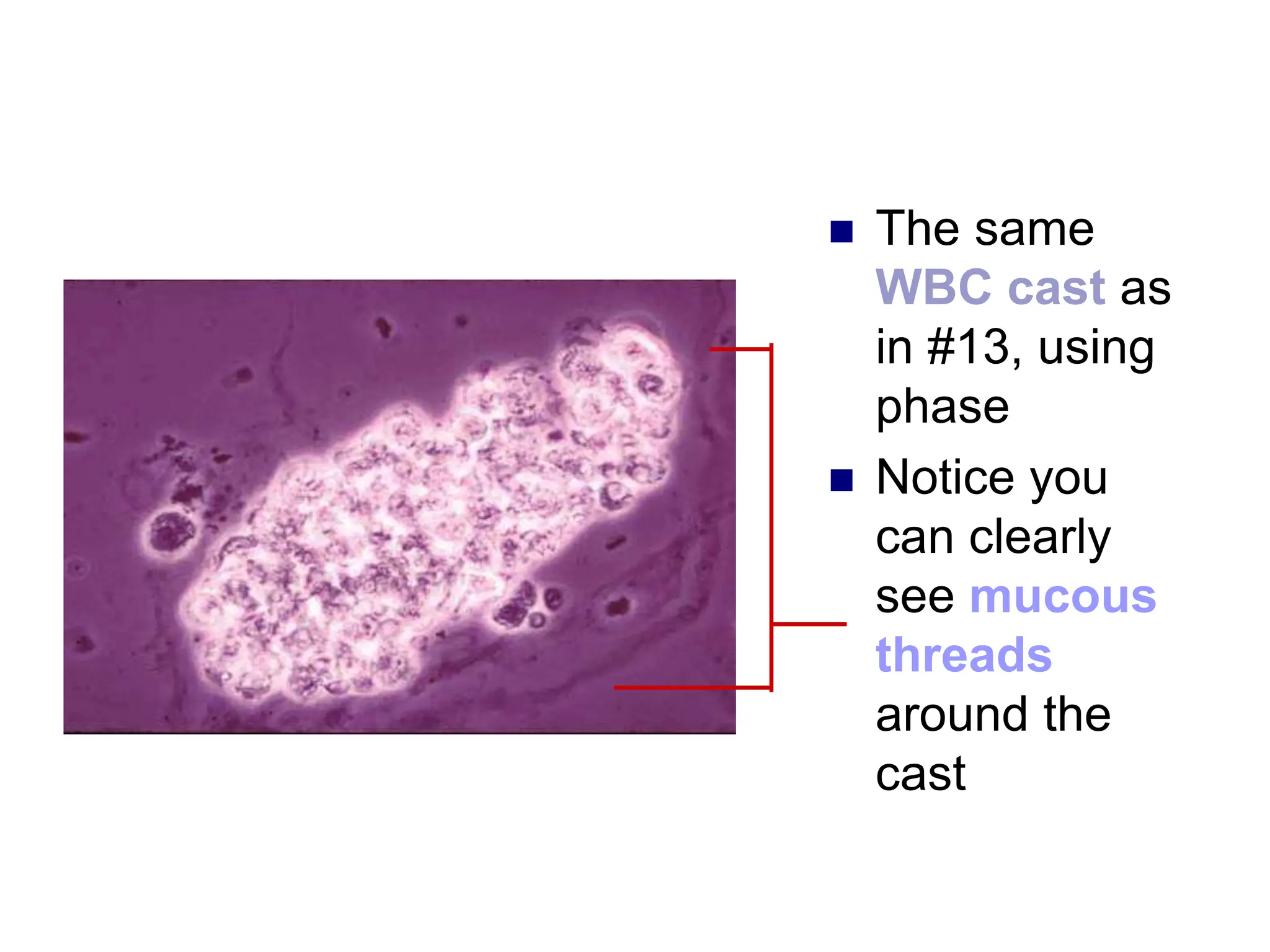  The same
WBC cast as
in #13, using
phase
 Notice you
can clearly
see mucous
threads
around the
cast
 
