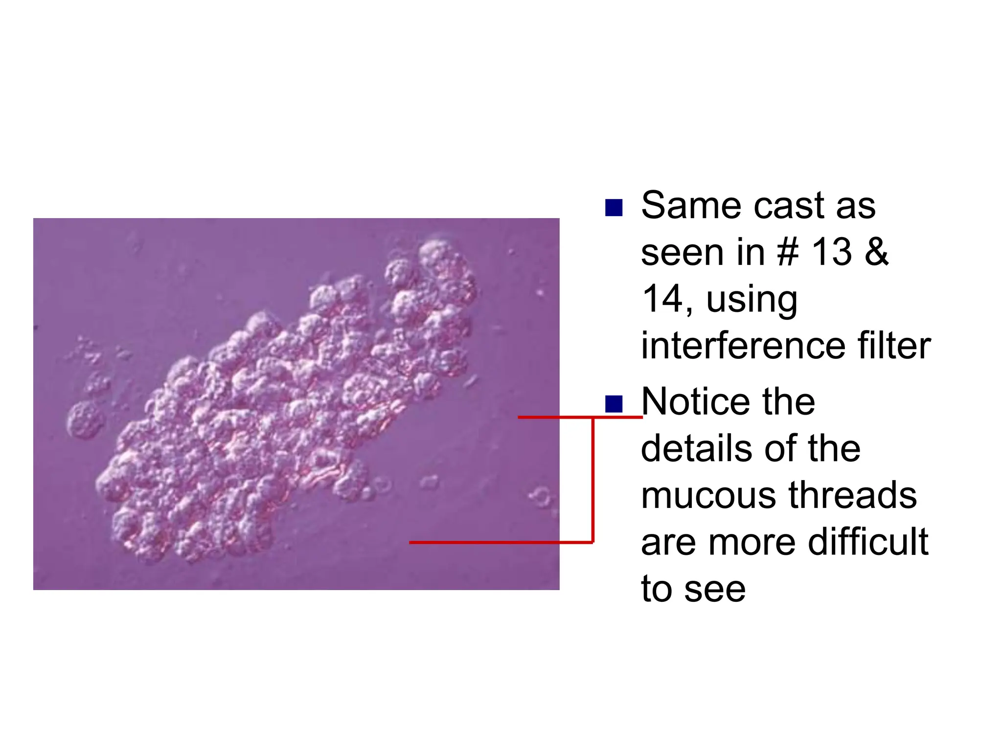  Same cast as
seen in # 13 &
14, using
interference filter
 Notice the
details of the
mucous threads
are more difficult
to see
 