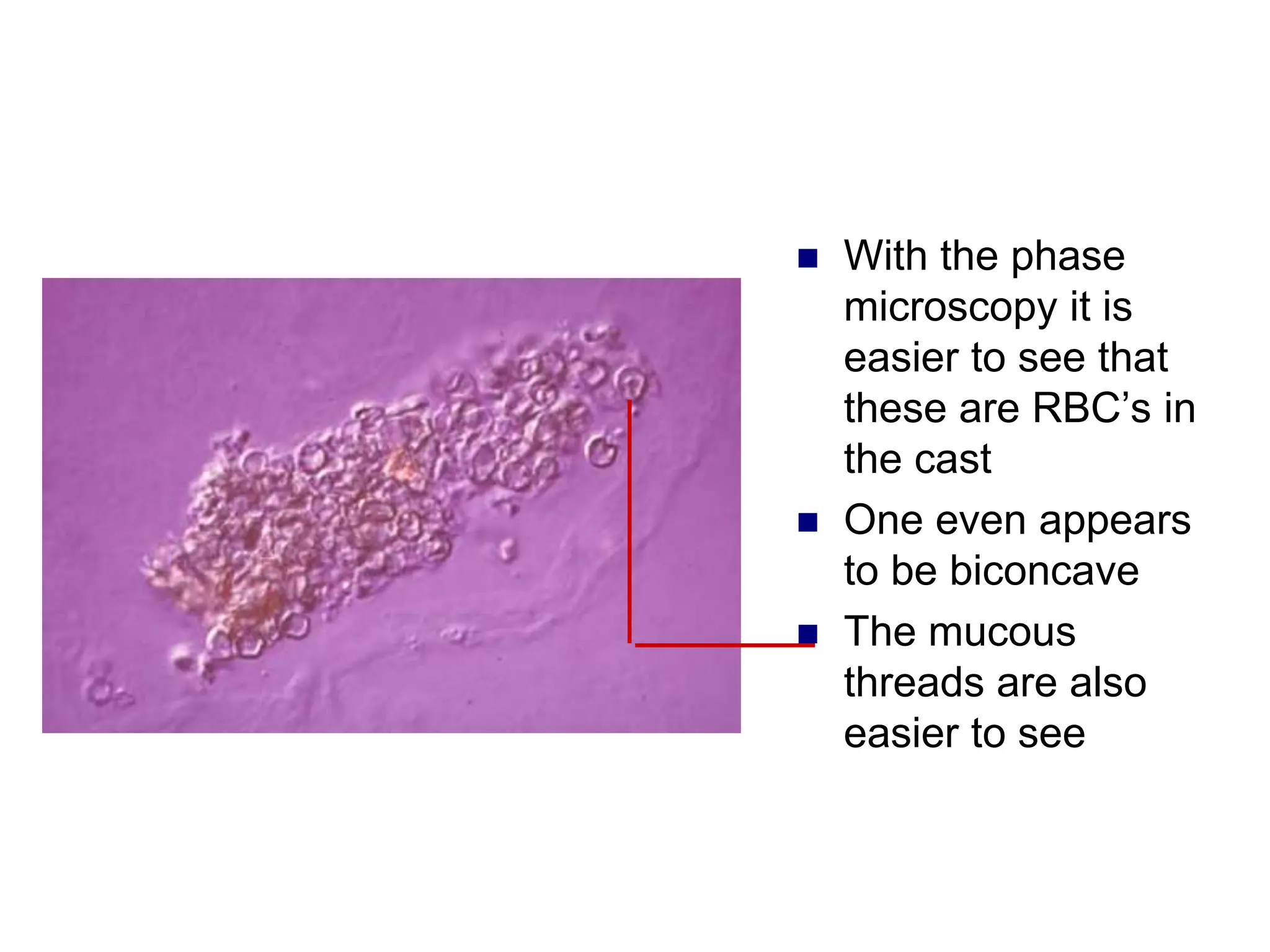  With the phase
microscopy it is
easier to see that
these are RBC’s in
the cast
 One even appears
to be biconcave
 The mucous
threads are also
easier to see
 