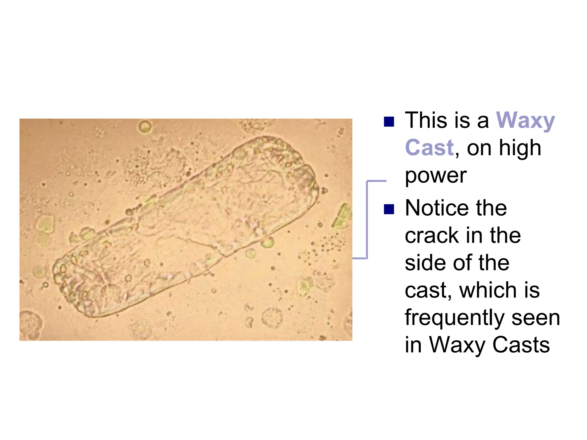  This is a Waxy
Cast, on high
power
 Notice the
crack in the
side of the
cast, which is
frequently seen
in Waxy Casts
 