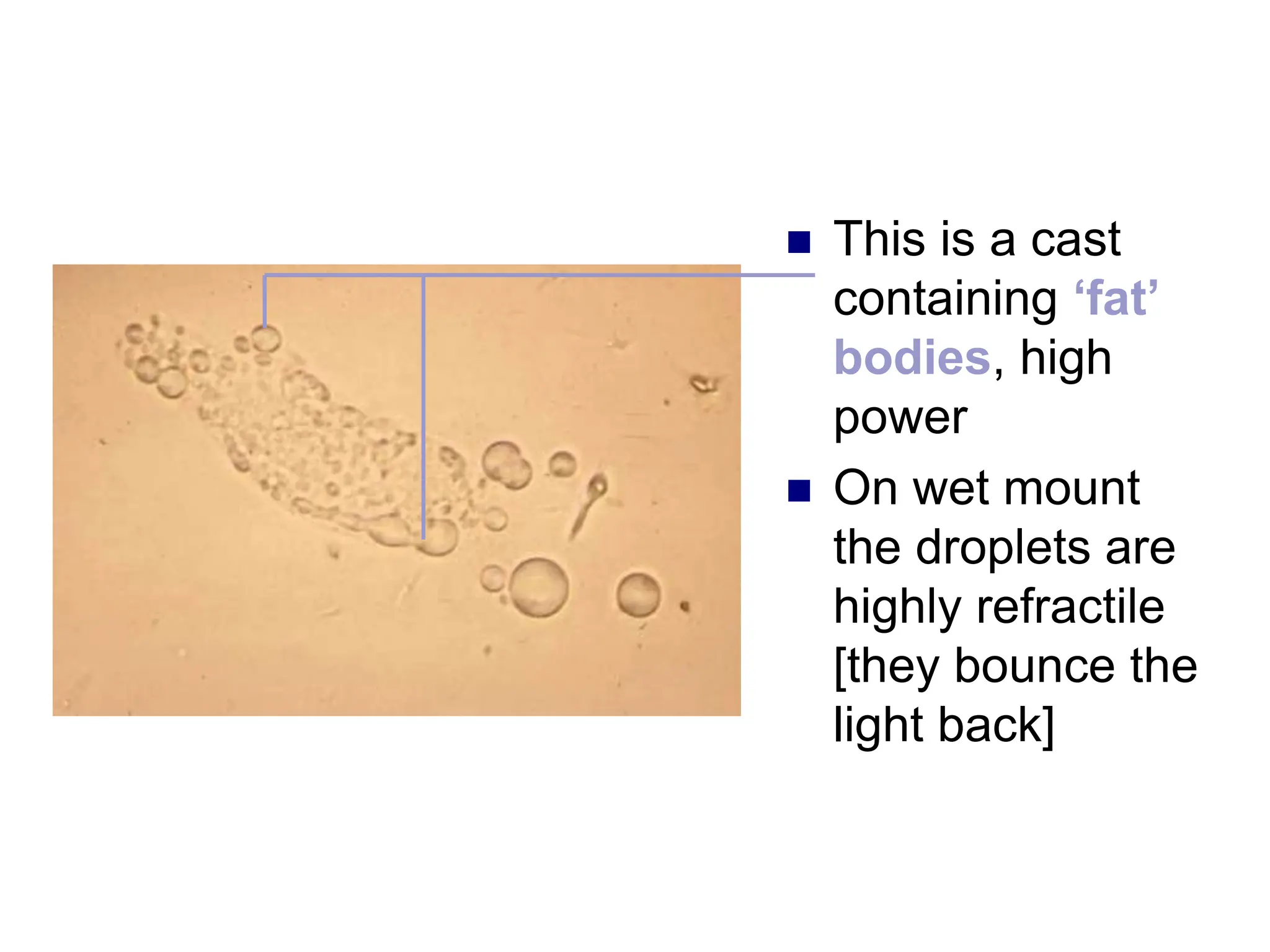 This is a cast
containing ‘fat’
bodies, high
power
 On wet mount
the droplets are
highly refractile
[they bounce the
light back]
 