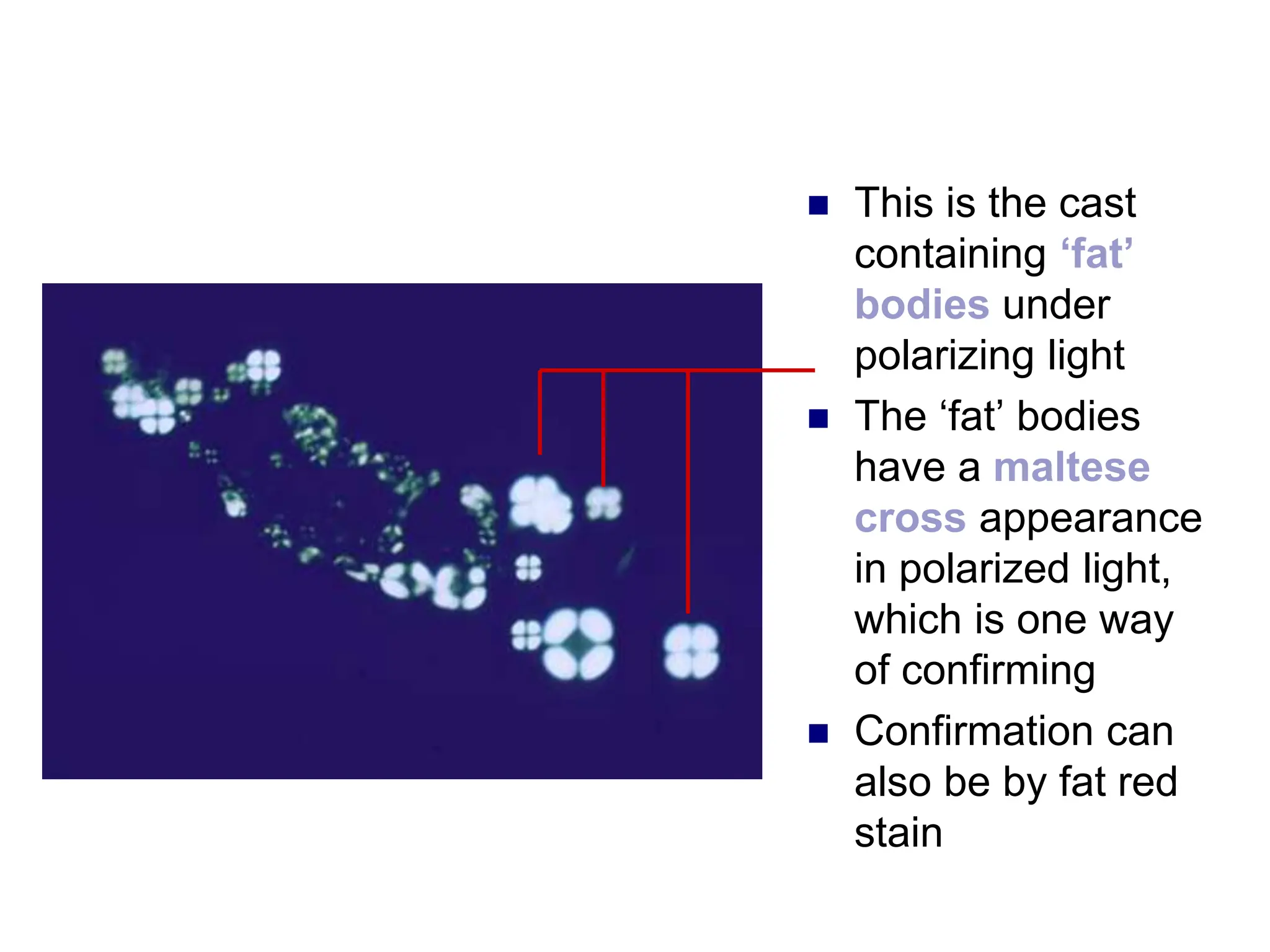  This is the cast
containing ‘fat’
bodies under
polarizing light
 The ‘fat’ bodies
have a maltese
cross appearance
in polarized light,
which is one way
of confirming
 Confirmation can
also be by fat red
stain
 