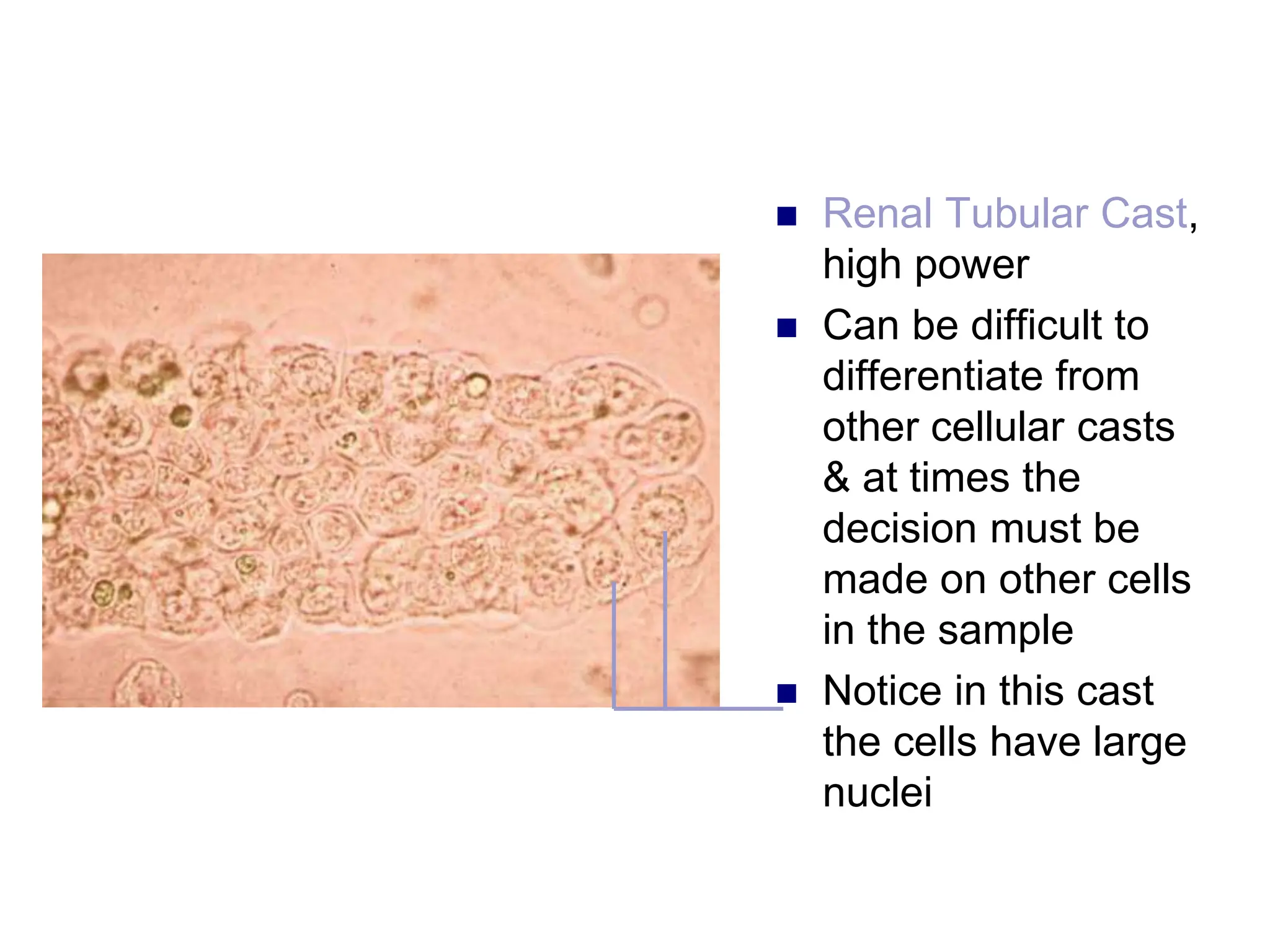  Renal Tubular Cast,
high power
 Can be difficult to
differentiate from
other cellular casts
& at times the
decision must be
made on other cells
in the sample
 Notice in this cast
the cells have large
nuclei
 