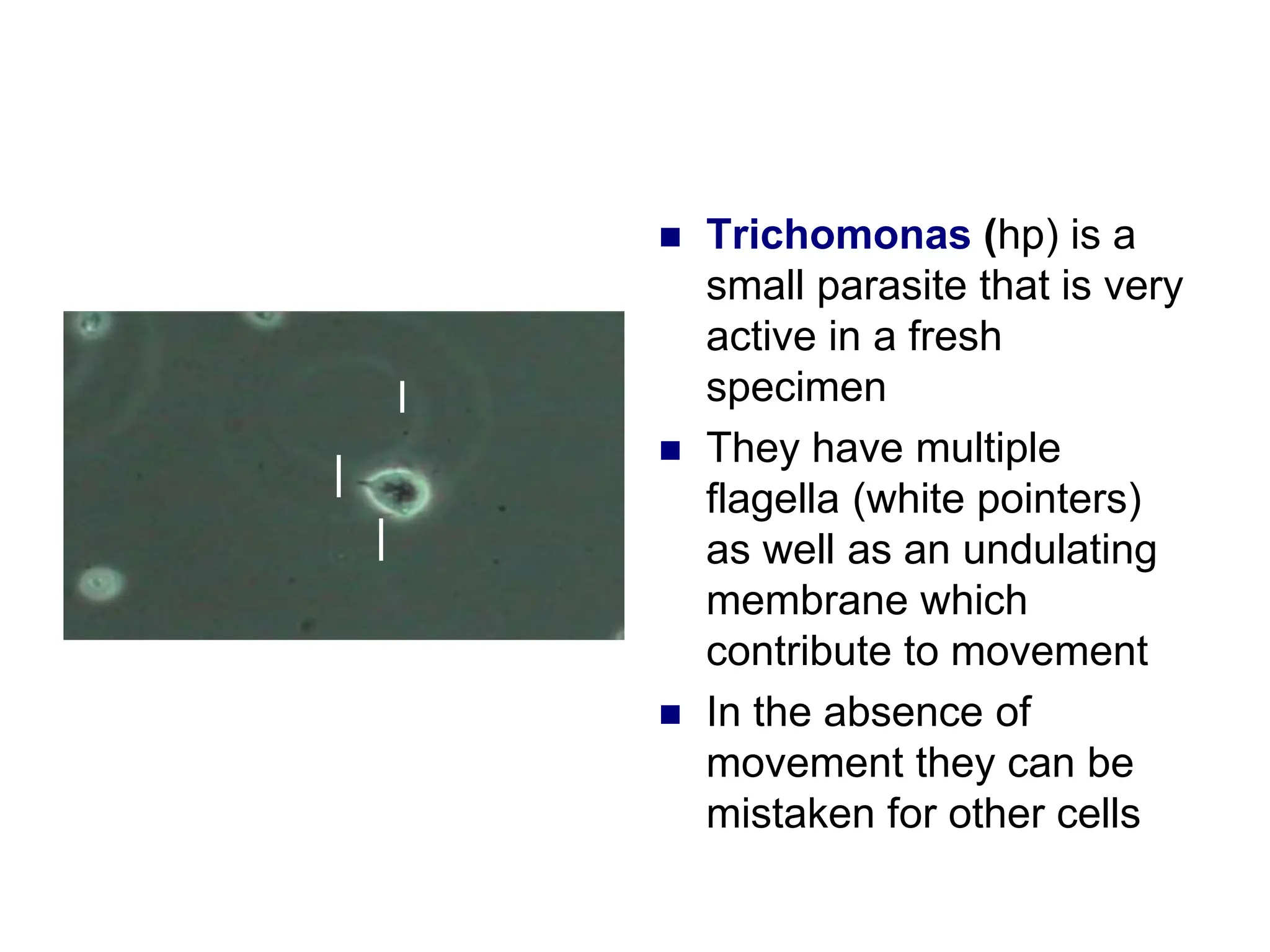  Trichomonas (hp) is a
small parasite that is very
active in a fresh
specimen
 They have multiple
flagella (white pointers)
as well as an undulating
membrane which
contribute to movement
 In the absence of
movement they can be
mistaken for other cells
 