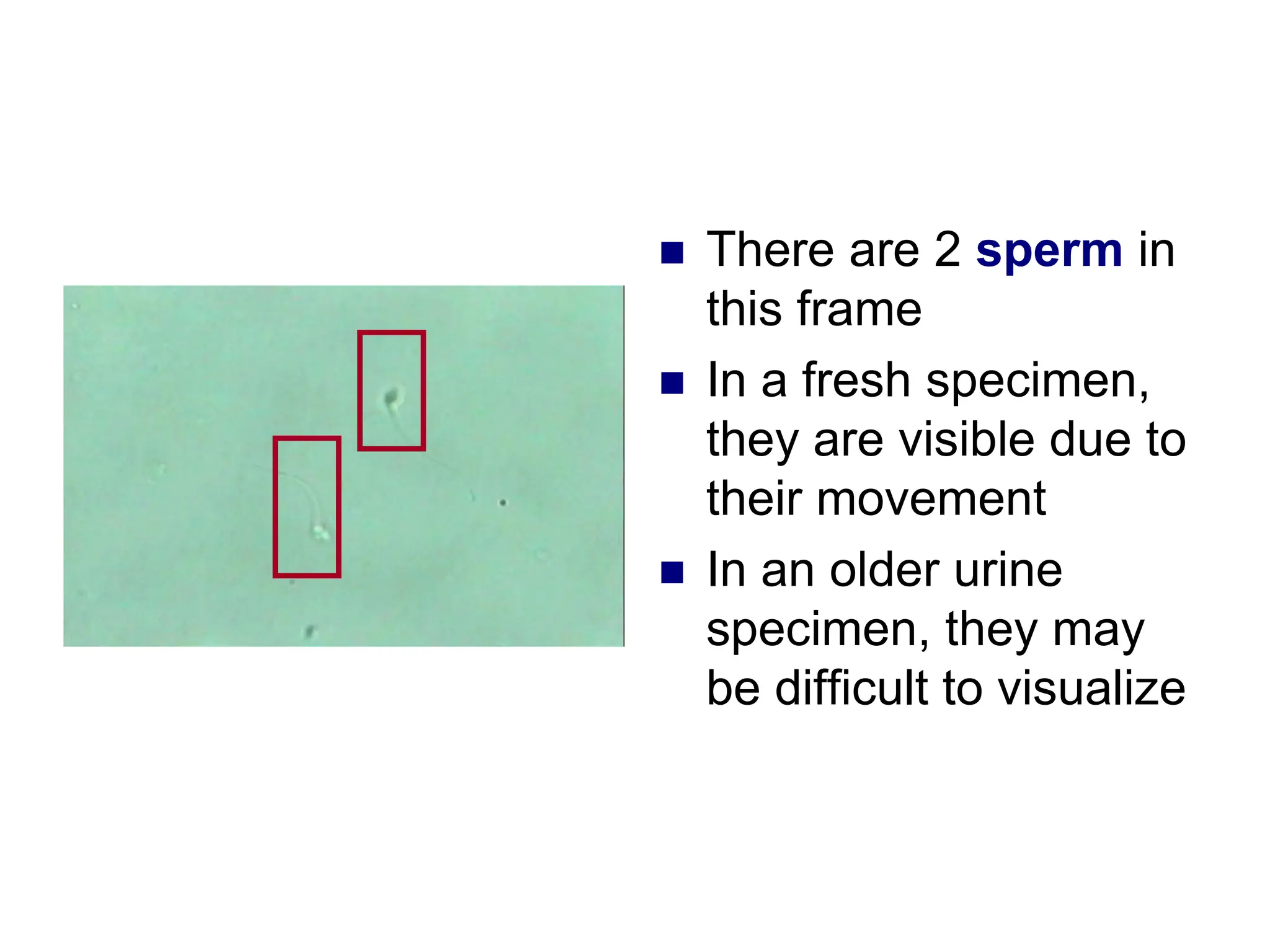  There are 2 sperm in
this frame
 In a fresh specimen,
they are visible due to
their movement
 In an older urine
specimen, they may
be difficult to visualize
 