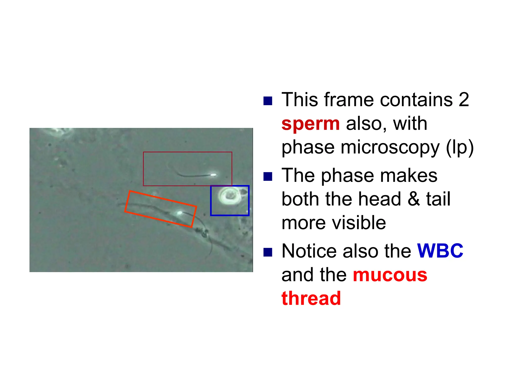  This frame contains 2
sperm also, with
phase microscopy (lp)
 The phase makes
both the head & tail
more visible
 Notice also the WBC
and the mucous
thread
 