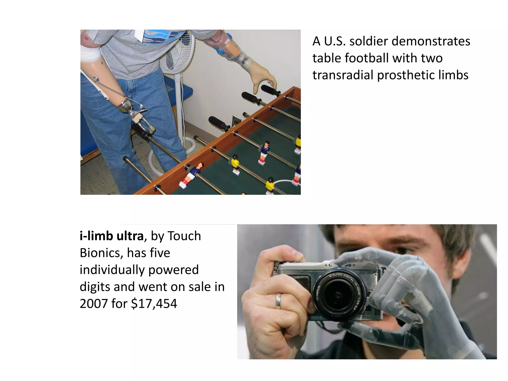 A U.S. soldier demonstrates
table football with two
transradial prosthetic limbs
i-limb ultra, by Touch
Bionics, has five
individually powered
digits and went on sale in
2007 for $17,454
 