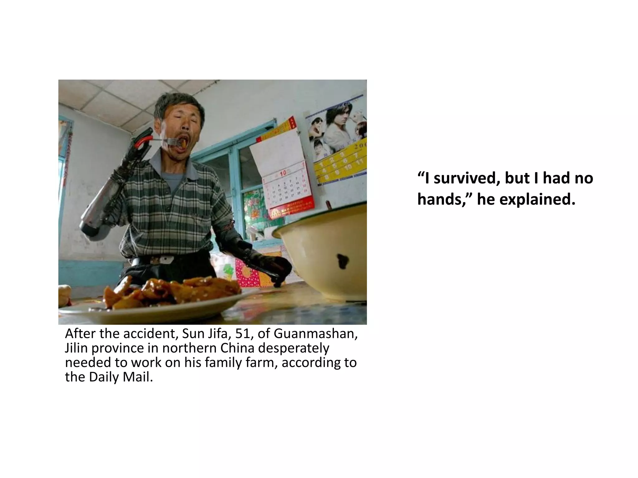 “I survived, but I had no
hands,” he explained.
After the accident, Sun Jifa, 51, of Guanmashan,
Jilin province in northern China desperately
needed to work on his family farm, according to
the Daily Mail.
 