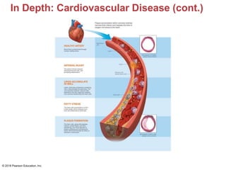In Depth: Cardiovascular Disease (cont.)
© 2018 Pearson Education, Inc.
 