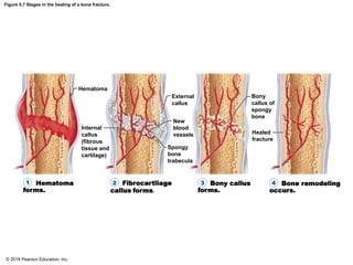 Initial Callus Formation Anatomy and Physiology. CHAPTER 5 Skeletal System | PDF