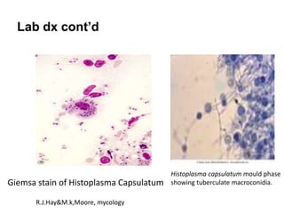 Lab dx cont’d
Giemsa stain of Histoplasma Capsulatum
Histoplasma capsulatum mould phase
showing tuberculate macroconidia.
...