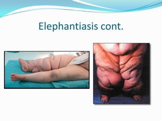 Elephantiasis cont.