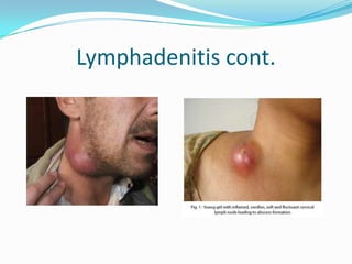 Lymphadenitis cont.